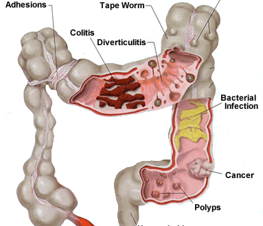 Ulcerative Colitis - Causes, Risk factors, Symptoms ... diagram of colitis 