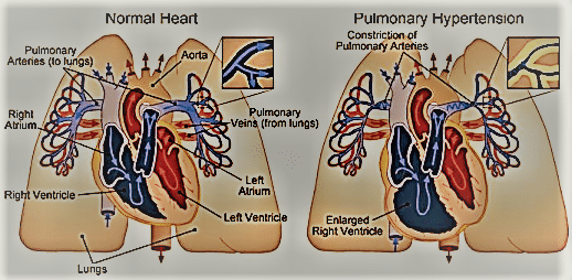 primary-pulmonary-hypertension-causes-risk-factors-symptoms