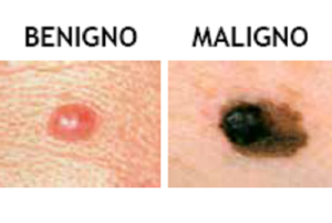 what does melanoma look like
